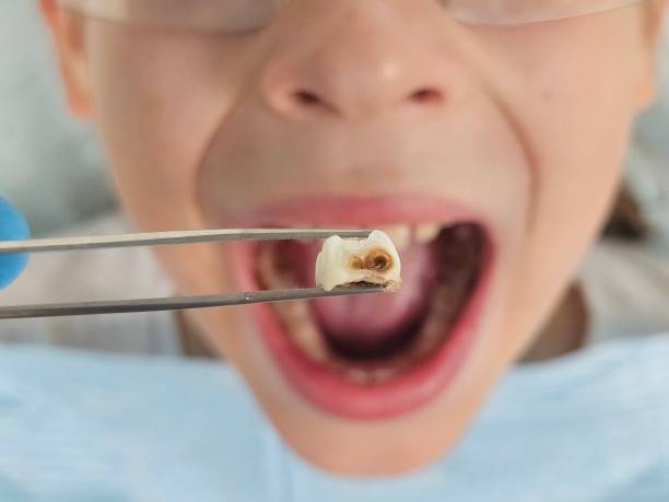 Best Emergency Broken Tooth Repair in Powell, WY